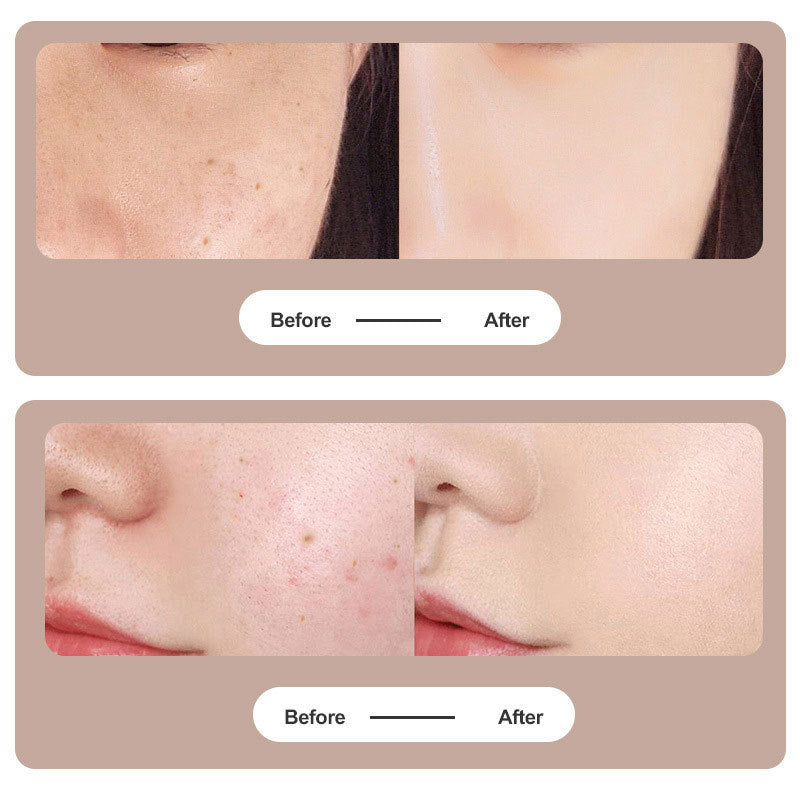 Luxury Plasma Pen — Professional Precision Skin Refinement & Skin Tag Device | USB Rechargeable